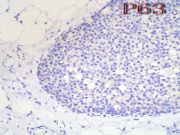 54岁女性，乳腺肿物1*0.8*0.8cm图9