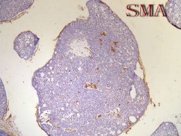 54岁女性，乳腺肿物1*0.8*0.8cm图11