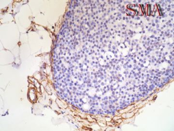 54岁女性，乳腺肿物1*0.8*0.8cm图14