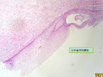 复杂的左卵巢肿物及右侧卵巢病变（免疫组化结果公布）新传大网膜图片图1