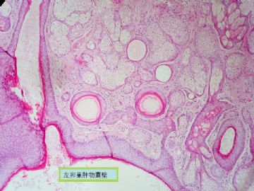 复杂的左卵巢肿物及右侧卵巢病变（免疫组化结果公布）新传大网膜图片图4