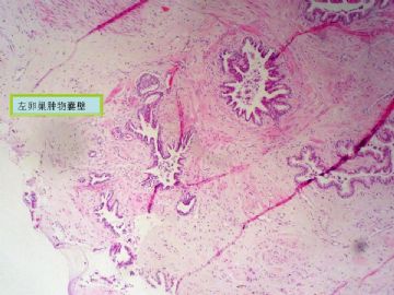 复杂的左卵巢肿物及右侧卵巢病变（免疫组化结果公布）新传大网膜图片图5