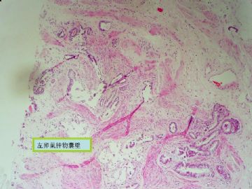 复杂的左卵巢肿物及右侧卵巢病变（免疫组化结果公布）新传大网膜图片图6