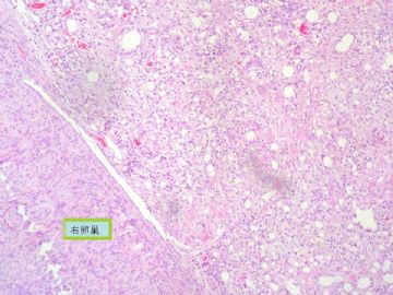 复杂的左卵巢肿物及右侧卵巢病变（免疫组化结果公布）新传大网膜图片图15