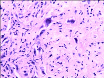 宫颈间质中散在异型细胞（补充了免疫标记图片）图3