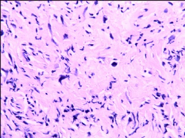 宫颈间质中散在异型细胞（补充了免疫标记图片）图4