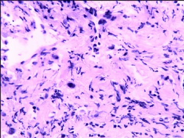 宫颈间质中散在异型细胞（补充了免疫标记图片）图5