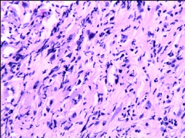 宫颈间质中散在异型细胞（补充了免疫标记图片）图7