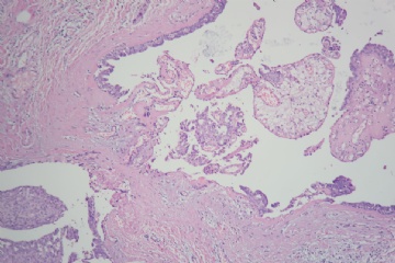 乳腺乳头状瘤伴不典型增生图6