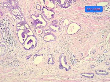 前列腺癌图22