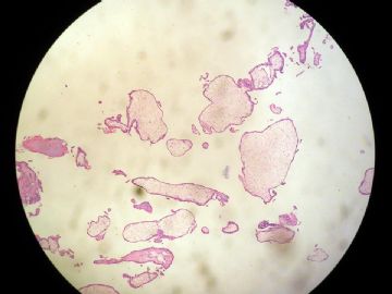 宫内膜水泡图2