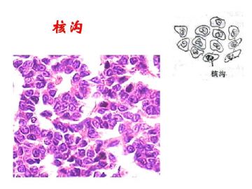 细胞核形态学诊断病理学中的意义（二）图5