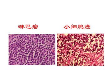 细胞核形态学诊断病理学中的意义（二）图9
