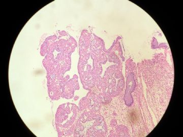 22岁宫颈活检图2
