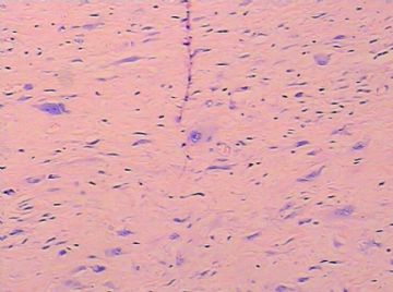 请问是平滑肌肉瘤吗图3