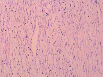 请问是平滑肌肉瘤吗图7