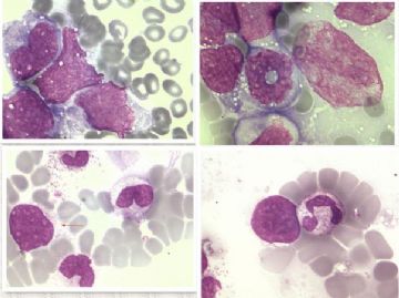 男 75 末梢血像 出现大量异常细胞 急求答案图8