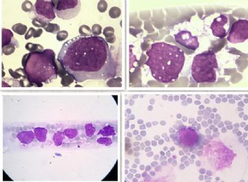 男 75 末梢血像 出现大量异常细胞 急求答案图9