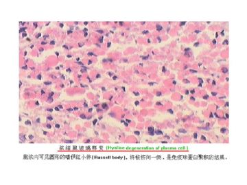 细胞核的形态学在诊断病理学中的意义(四）图12