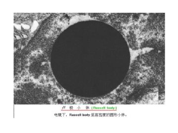 细胞核的形态学在诊断病理学中的意义(四）图13