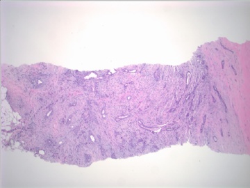 86 y/f bilateral breast mass (cqzB-40)图1