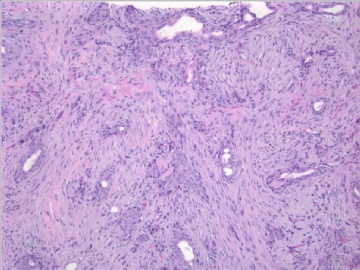 86 y/f bilateral breast mass (cqzB-40)图2