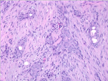 86 y/f bilateral breast mass (cqzB-40)图3