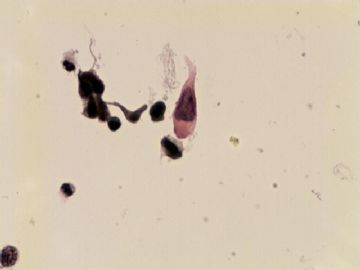 TCT(HISL\疑癌）-附活检结果图12