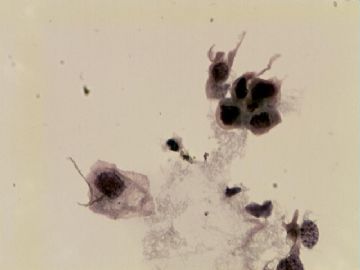 TCT(HISL\疑癌）-附活检结果图15