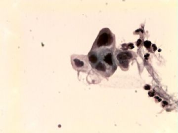 TCT(HISL\疑癌）-附活检结果图16