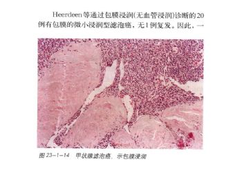 ZT:刘彤华院士谈甲状腺滤泡性肿瘤的鉴别诊断图4