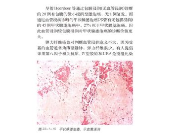 ZT:刘彤华院士谈甲状腺滤泡性肿瘤的鉴别诊断图7