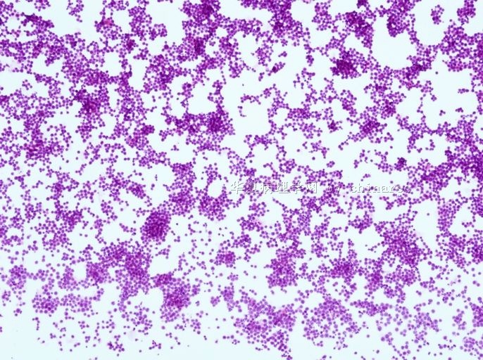 胸水液基细胞学-地坛2图1