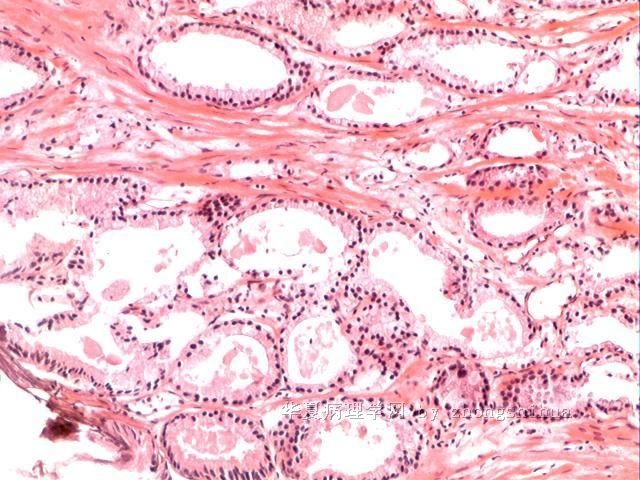 前列腺电切标本（癌？增生？）图10