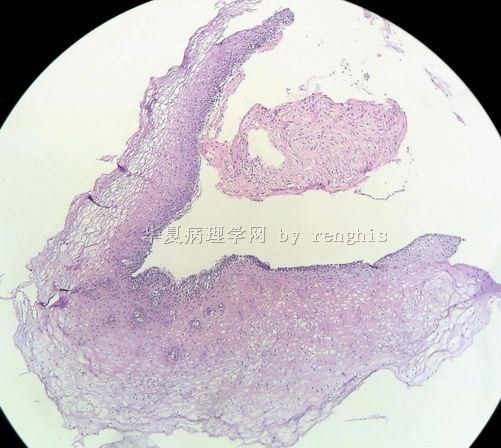 食管黏膜隆起性肿物图1