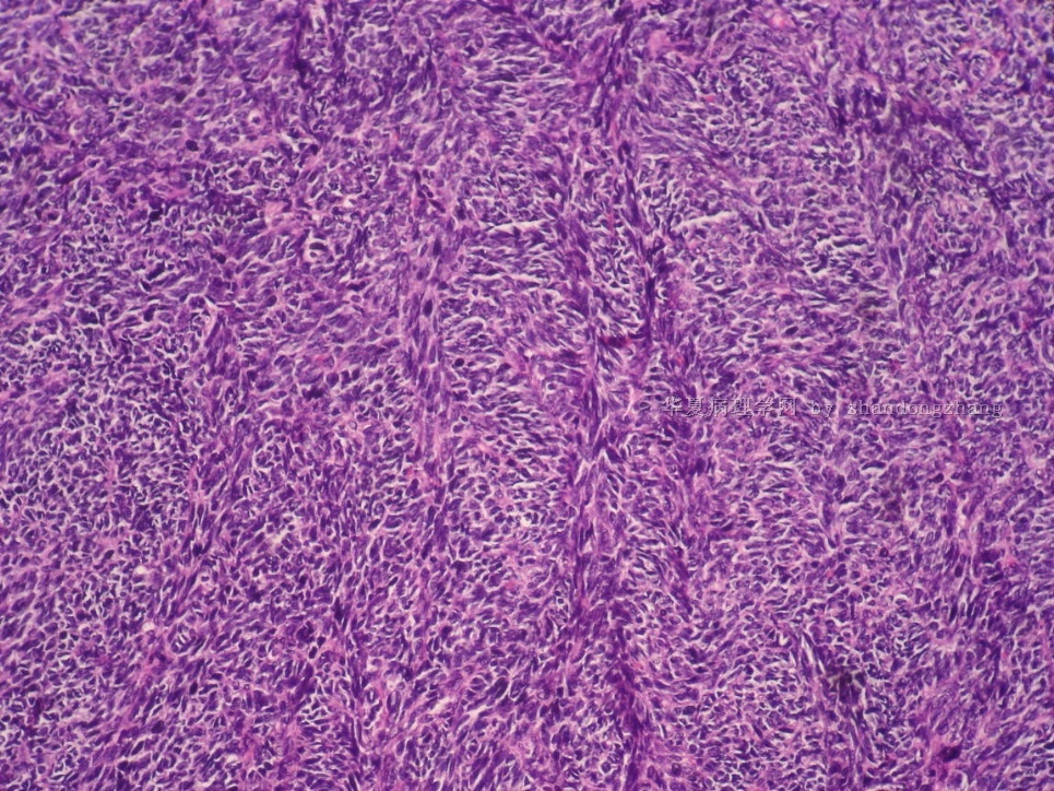 20101113-卵巢肿瘤图8