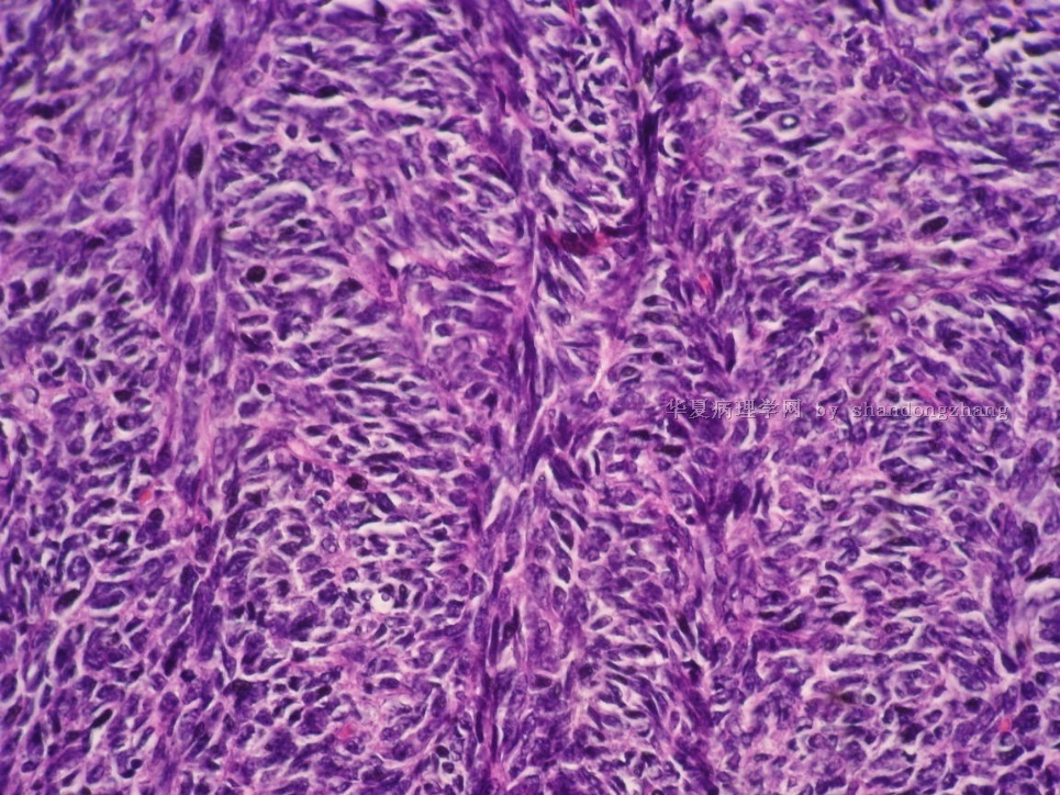 20101113-卵巢肿瘤图9