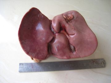 请教：新生儿肝脏（炎症？）图1