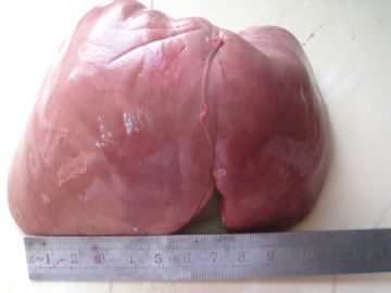 请教：新生儿肝脏（炎症？）图2