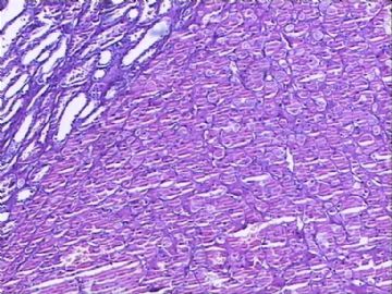 肾脏肿物:嗜酸细胞腺瘤?嗜酸细胞性嫌色细胞癌?
