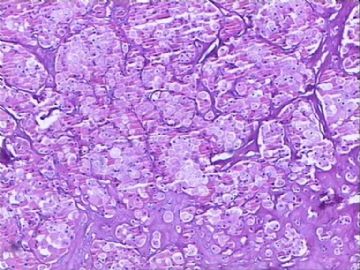 肾脏肿物：嗜酸细胞腺瘤？嗜酸细胞性嫌色细胞癌？图3