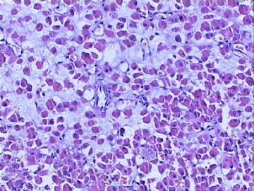 肾脏肿物：嗜酸细胞腺瘤？嗜酸细胞性嫌色细胞癌？图7