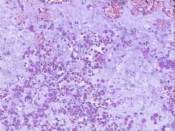 肾脏肿物：嗜酸细胞腺瘤？嗜酸细胞性嫌色细胞癌？图8
