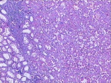 肾脏肿物：嗜酸细胞腺瘤？嗜酸细胞性嫌色细胞癌？图9