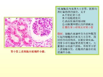 执业医师考试病理真题图解（2）图17