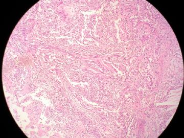 左乳腺肿块（新加免疫组化CK5/6等）图3
