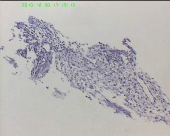 37岁女性胸腔肿物，病史不详，肿瘤？增生？图8