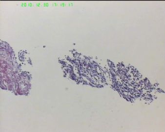 37岁女性胸腔肿物，病史不详，肿瘤？增生？图9