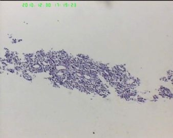 37岁女性胸腔肿物，病史不详，肿瘤？增生？图10