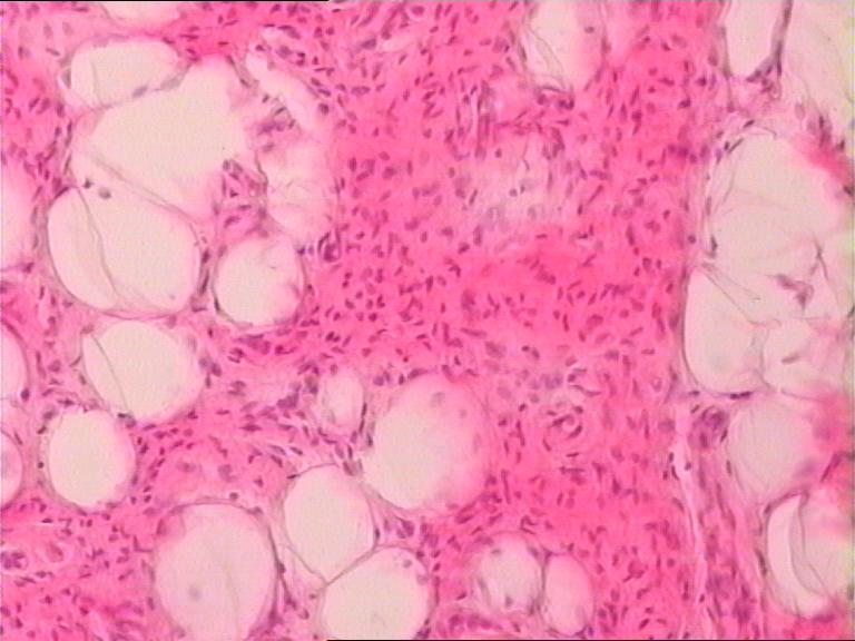 是梭形细胞脂肪瘤吗? - 专科病理>>软组织病理 - 华夏